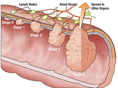 http://www.thegastrosurgeon.com/colorectal-surgery/