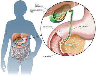 gallstones for stomach pain