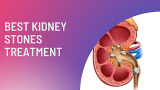 BEST KIDNEY STONES TREATMENT : Do You Really Need It?