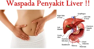 Mengobati serta Mencegah Penyakit pada Hati atau Liver