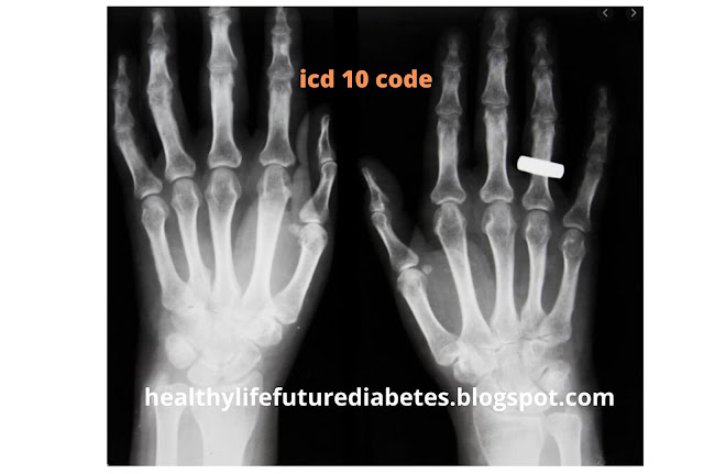  icd 10 code for osteoporosis