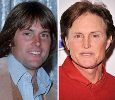 Bruce Jenner Worst Plastic Surgery on Bruce Jenner Plastic Surgery  Before And After Facelift