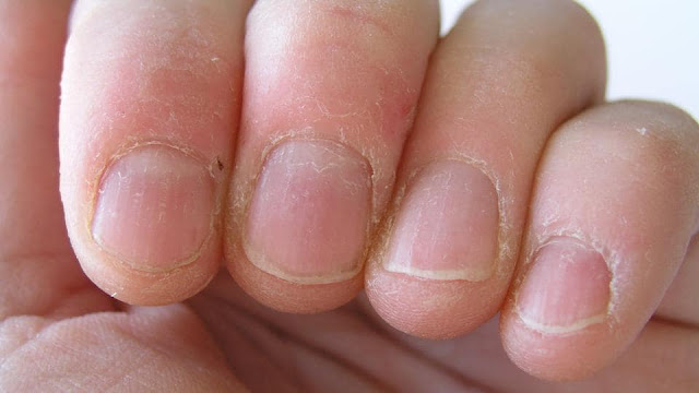 cracked-skin-around-children's-nails