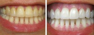 Tẩy trắng răng bằng Laser Whitening giá bao nhiêu tiền?