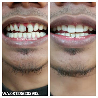 foto, gambar, gigi depan keropos Permata Dental Bali| sebelum dan sesudah gigi keropos diperbaiki di Permata Dental Bali | foto gigi keropos hitam Permata Dental Bali |gigi keropos karena sakit | gigi keropos berlubang | gigi keropos depan| gigi keropos bagian belakang | foto gigi keropos yang sudah diperbaiki Permata Dental Bali |  gigi keropos bagian depan| foto gigi keropos dan patah, foto gigi keropos oleh Permata Dental Bali, Bali Hits, Bali banget, area Bali, Bali kota, area kampus bali. veneer gigi keropos  Bali | veneer gigi keropos badung | veneer gigi keropos nusadua | veneer gigi keropos ngurahrai| veneer gigi keropos denpasar | veneer gigi kropos denpasar kota | veneer gigi keropos Bali | veneer gigi keropos gatsu | |veneer gigi keropos|  depan | veneer gigi keropos  atas | veneer gigi keropos  bawah | veneer gigi keropos  belakang |veneer gigi berlubang bali| veneer gigi berlubang Bali | veneer gigi berlubang nusadua| veneer gigi berlubang ngurahrai| veneer gigi berlubang Badung | veneer gigi berlubang depasar kota | veneer gigi berlubang denpasar| veneer gigi berlubang gatsu| veneer gigi berlubang jimbaran| veneer gigi berlubang bagus Permata Dental Bali | veneer gigi berlubang baik di Permata Dental Bali | veneer gigi berlubang cepat di Permata Dental Bali | veneer gigi berlubang murah di Permata Dental Bali | veneer gigi berlubang aman | veneer gigi berlubang mudah di Permata Dental Bali | veneer gigi berlubang promo Permata Dental Bali | gambar veneer gigi berlubang Permata Dental Bali | gambar sebelum dan sesudah veneer gigi hitam dan berlubang  veneer gigi hitam Bali | veneer gigi hitam Bali | veneer gigi hitam denpasar | veneer gigi hitam jimbaran | veneer gigi hitam nusadua | veneer gigi hitam Bali kota | veneer gigi hitam ngurahrai| veneer gigi hitam badung | veneer gigi hitam gatsu | veneer gigi hitam bagus | veneer gigi hitam baik | veneer gigi hitam cepat di Permata Dental Bali | veneer gigi hitam murah di Permata Dental Bali | veneer gigi hitam aman | veneer gigi hitam mudah di Permata Dental Bali | veneer gigi hitam promo Permata Dental Bali | gambar veneer gigi hitam Permata Dental Bali | gambar sebelum dan sesudah veneer gigi hitam dan berlubang Permata Dental