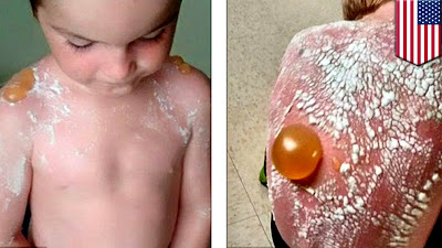 Sunburned kids hospitalized after daycare forgets to put sunscreen on them