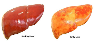 Fatty Liver Disease