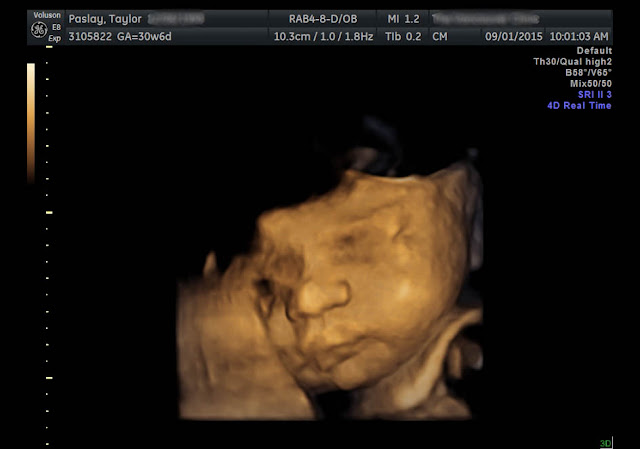 3D ultrasound 31 weeks