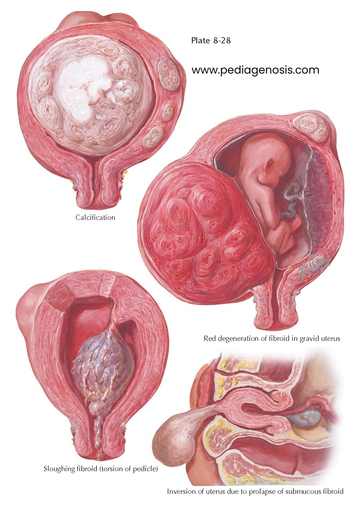 MYOMA (FIBROID) II—SECONDARY CHANGES