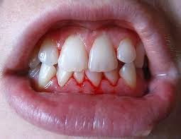 what causes bleeding gums