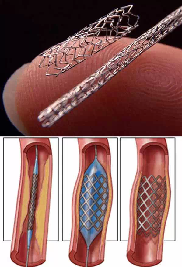 支架是這樣放進心臟的