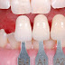 Khắc phục răng nhiễm màu như thế nào?