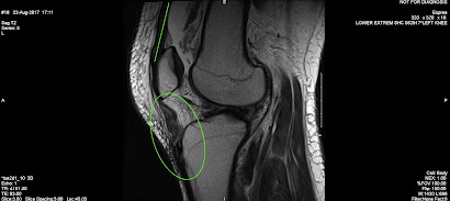 MRI image of knee