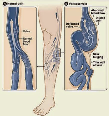 http://en.wikipedia.org/wiki/Compression_stockings