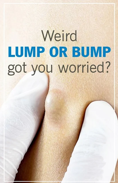 Lumps and Bumps on Your Body: When You Should Worry