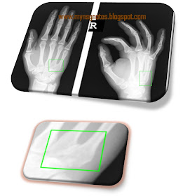 5th Metacarpal Fracture Metacarpal base fractures-2.bp.blogspot.com