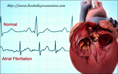 Waspadalah Dengan Adanya Penyakit Atrial Fibrilasi Pada Seorang Pekerja Keras