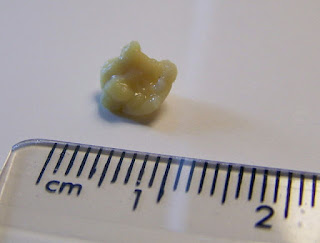 tonsils-ston