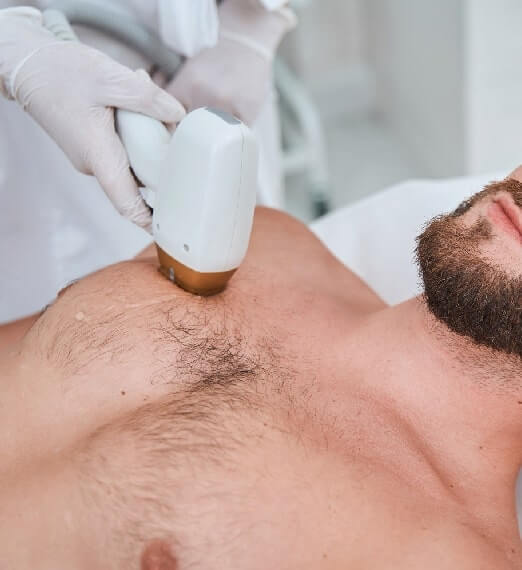 Laser Hair Removal