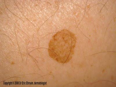 Brown Spots On Skin Cancer