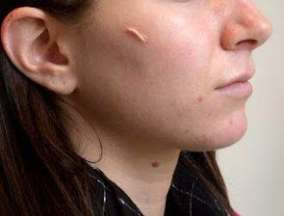 Pengobatan yang Aman Keloid di Wajah