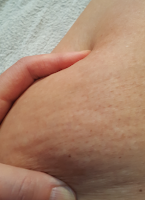 Cellulite treatment 2 weeks