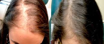 बालों को झड़ने से बचाने के लिए घरेलू उपाय-झड़ते हुए बालों को रोकने के उपाय