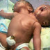 Bayi Berkepala Dua di Gorontalo