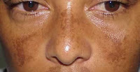 Cara Menghilangkan Melasma Pada Wajah