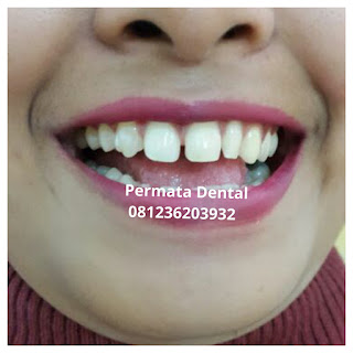 gambar foto contoh sebelum dan sesudah veneer gigi kelinci buatan manis cantik bali jember banyuwangi murah berkualitas di PERMATA DENTAL gambar gigi rusak yang di veneer gigi yang tidak rapi gigi renggang gigi patah cuil rompal pendek karies hitam kuning