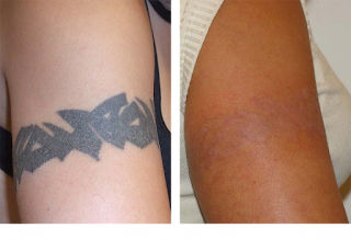 http://www.skinsolutionz.in/laser-treatment.html