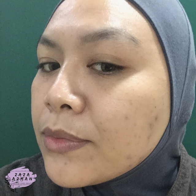 Dermalene Chemical Peel Pigmentation Treatment