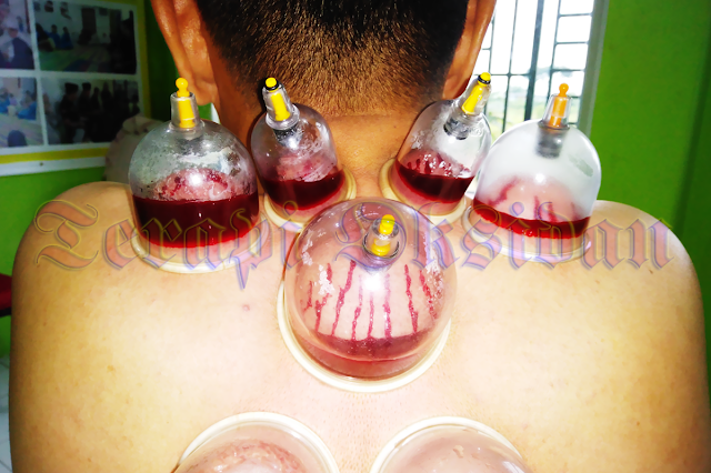 Disposing of Dirty Blood with Wet Cupping Therapy
