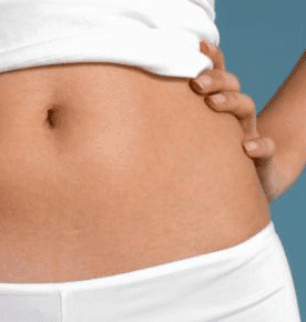 how to get rid of stretch marks