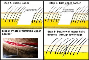 Hair transplant in Navi Mumbai