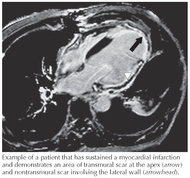 Cardiac magnetic resonance imaging: transmural and nontransmural scars