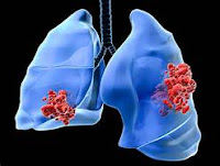lung cancer news,lung cancer treatment