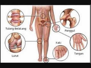 Cara Penyembuhan Penyakit Rematik Secara Alami