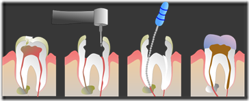 Root_Canal