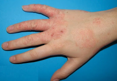 Eczema thể địa – Chàm da tổ đỉa