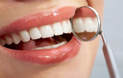 Răng sứ venus là gì? Có nên làm răng sứ venus? 2