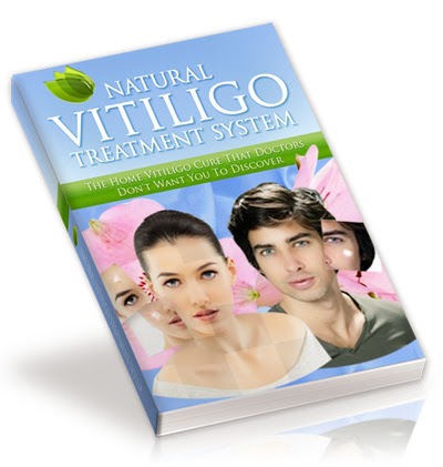  vitiligo treatment