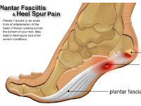 KHASIAT MINYAK KUTUS KUTUS UNTUK KELUHAN PLANTAR FASCIITIS