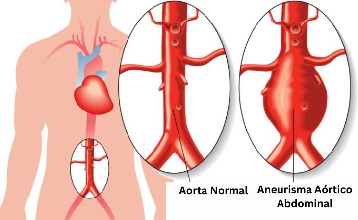 https://www.notasrosas.com/Aneurismas aórticos abdominales: afectan entre el 2 y el 12% a mayores de 65 años