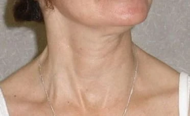 Patient with moderate left torticollis or neck rotation