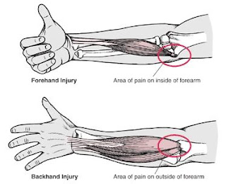 Diagnosis Constant Elbow Pain : Tennis Ellbow Treatment Options