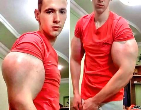 Russian boy Kirill Terhesin injects 1 liter Synthol into his biceps