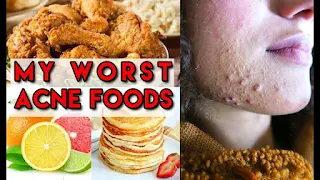 Worst acne foods