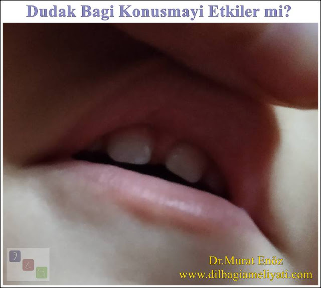 Dudak Bağı Konuşmayı Etkiler mi?