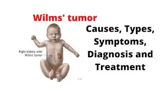 What Is Wilms' Tumor(WT)